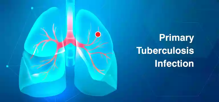  Primary Tuberculosis Infection: Signs, Diagnosis, and Treatment